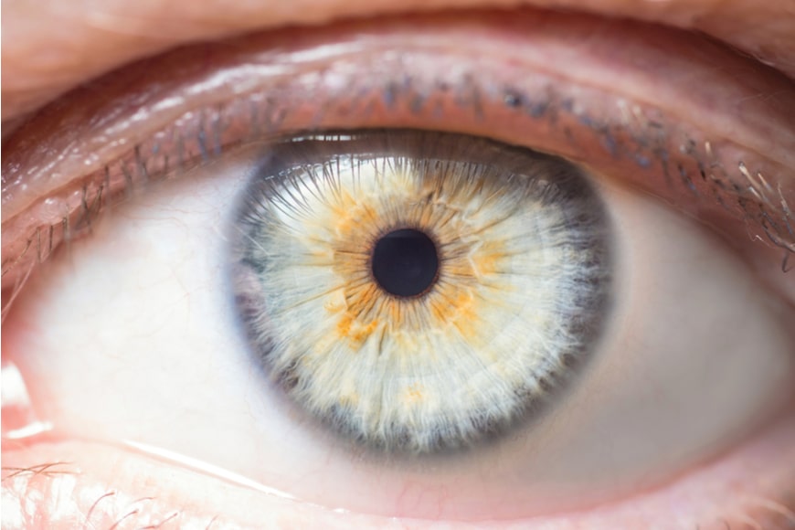 heterocromia iris