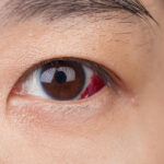 Un desgarro de retina puede ser un factor de riesgo para el desprendimiento de retina
