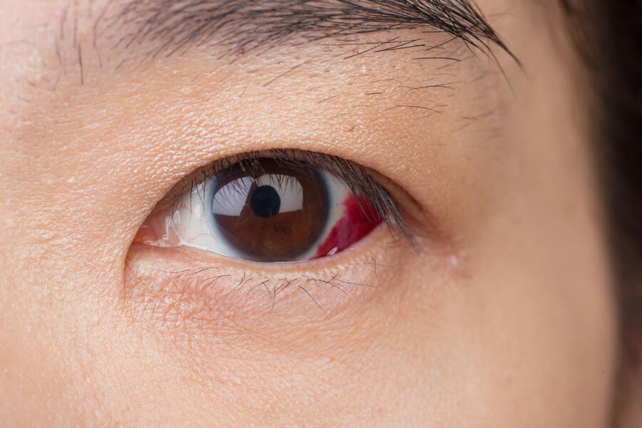 Un desgarro de retina puede ser un factor de riesgo para el desprendimiento de retina