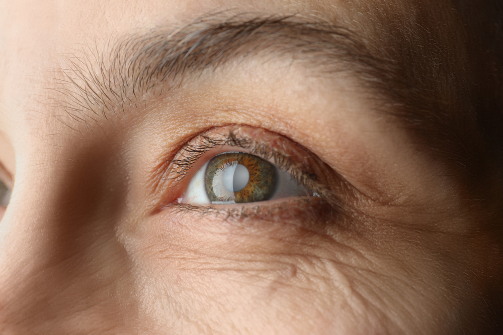 diferencia entre desgarro y desprendimiento de retina